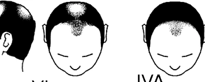 Estadio Norwood V: Rotura del puente medio